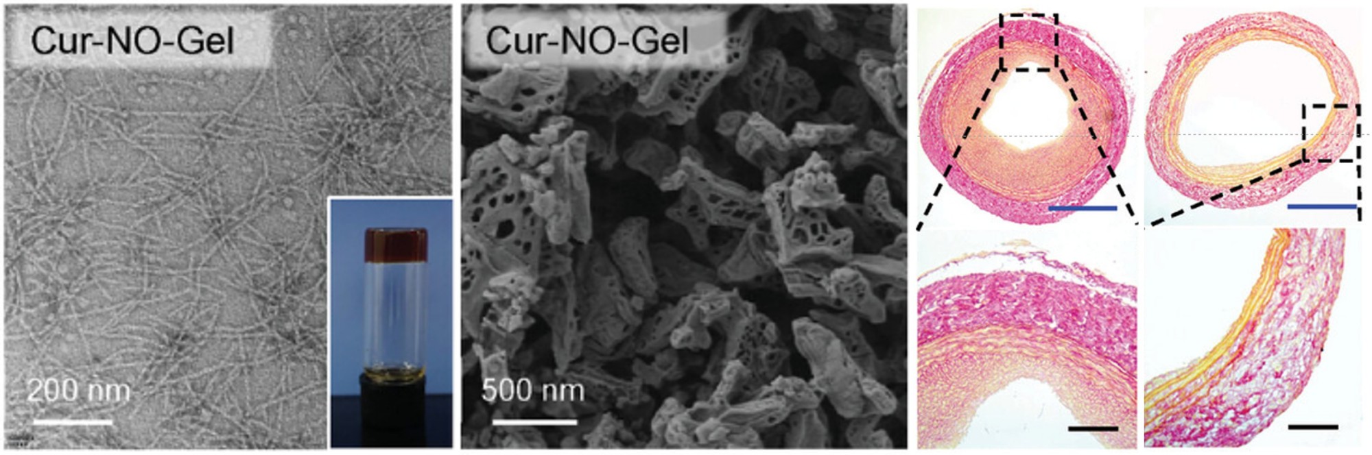 Anti-restenosis peptide hydrogel assists angioplasty